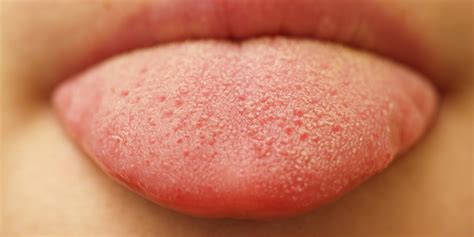 Oral Thrush What Bumps On Your Tongue May Be Telling You Huffpost