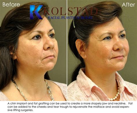 Chin And Neck Liposuction Before And After Gallery Dr Kolstad San