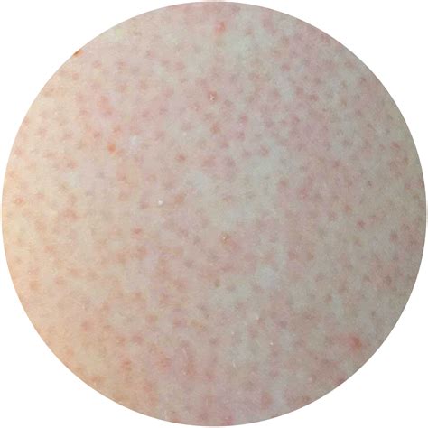 Learn All About Keratosis Pilaris Slmd Skincare By Sandra Lee Md