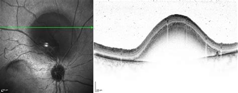 Macroaneurysm - OCT - Retina Image Bank