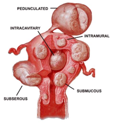 Fibroids Luke S Radiology Blog