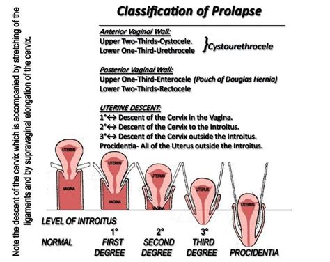 Prolaps Recti Uterine Prolapse Pelvic Organ Prolapse Prolapsed Uterus