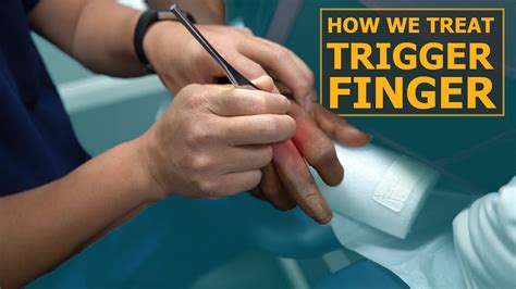 How We Treat Trigger Finger Physical Therapy Youtube