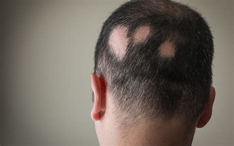 alopecia awareness month september 2023 uk hair consultants