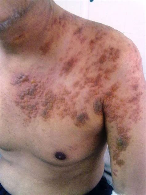Multidermatomal Herpes Zoster Sundriyal Et Al 2014 Bmj Case Reports