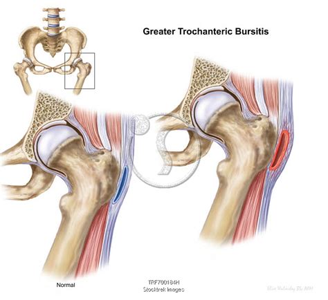 Detail Showing Greater Trochanter Bursitis In Hip Joint Stocktrek Images