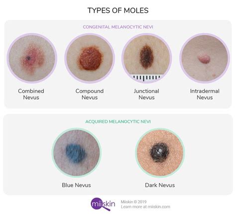 Extensive Mole Guide With Images Learn About Birthmarks Moles And How