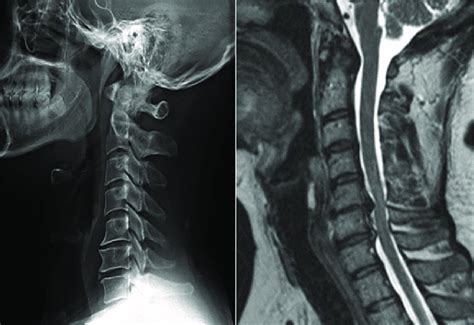Degenerative Changes At C5c6 Level And Symptomatic Disc Herniation At