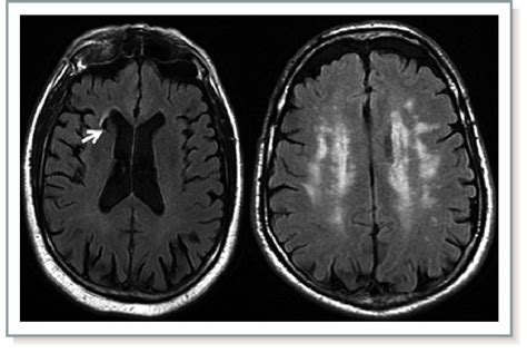 Mri Brain Small Vessel Disease
