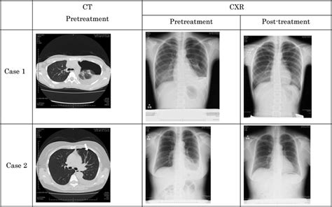 Chest Computed Tomography Ct And Chest X Ray Cxr Of Pretreatment