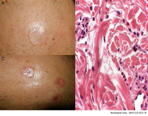 Granuloma Annular Like Lesions As A Manifestation Of Eosinophilic