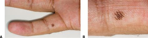 Benign Acquired Superficial Skin Lesions Of The Hand Journal Of Hand