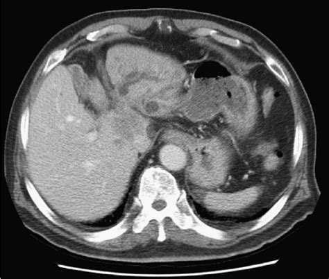 A Contrast Enhanced Ct Scan Shows Tumor With Indistinct Borders