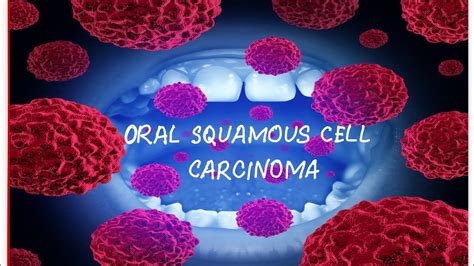 Oral Squamous Cell Carcinoma Youtube