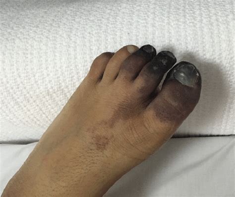 Top 94 Images Leg Discoloration Due To Poor Circulation Pictures Updated