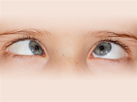 Reason For Squint Eyes In Indian Children Diagnosis And Treatment Mfine