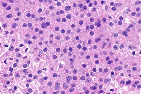 Hürthle Cell Neoplasm Libre Pathology