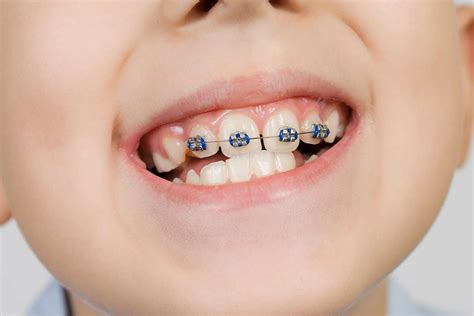 3 Benefits Of Braces For Kids Pediatric Orthodontics Houston Texas