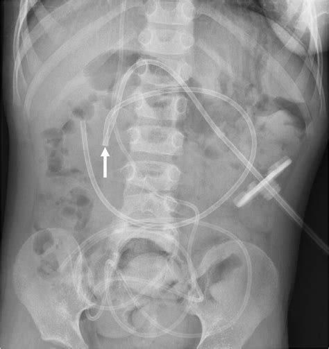 Kinked Gastrojejunostomy Tube In A 4 Year Old Boy An Anteroposterior