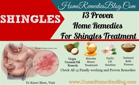 13 Powerful Home Remedies For Shingles Treatment Home Remedies Blog