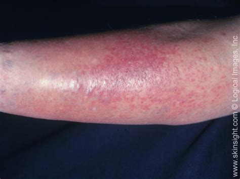 Stasis Dermatitis National Eczema Association