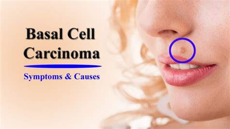 Basal Cell Carcinoma Symptoms And Causes