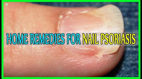 Best Home Remedies For Nail Psoriasis Youtube