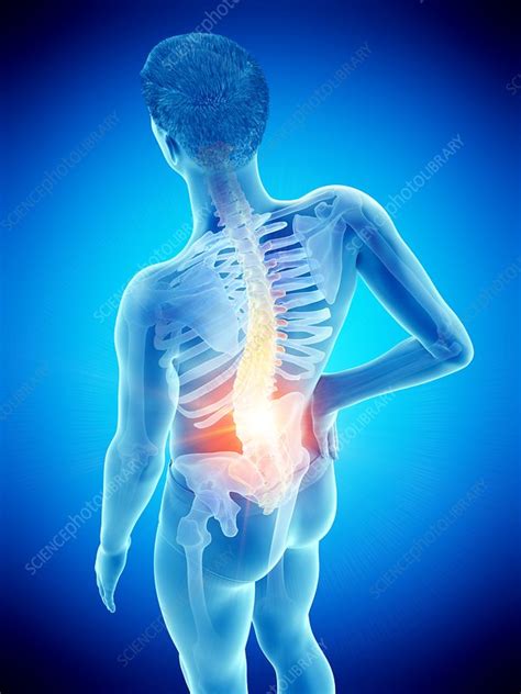 Back Pain Conceptual Illustration Stock Image F0257408 Science