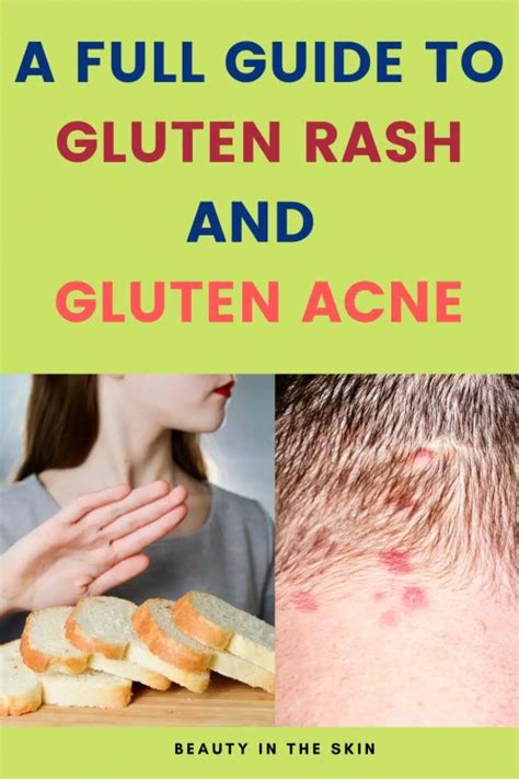 A Full Guide To Gluten Rash And Gluten Acne Beauty In The Skin