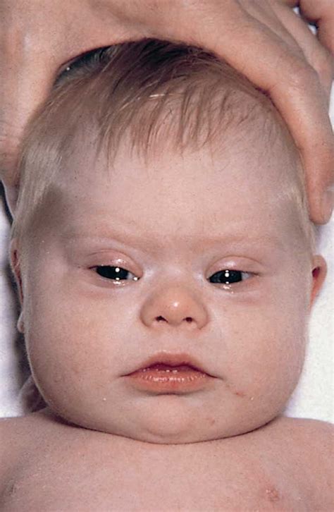 It is lifelong and present from conception. Down Syndrome. Causes, symptoms, treatment Down Syndrome