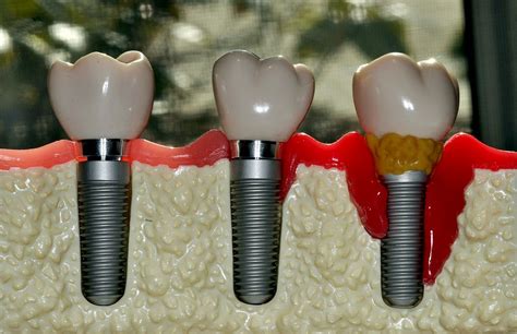 What Are The Reasons Of Dental Implant Failure Directorio Odontológico