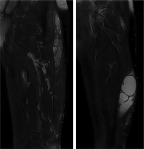 Coronal T2 Fat Saturated Images Of The Left Thigh Intramuscular