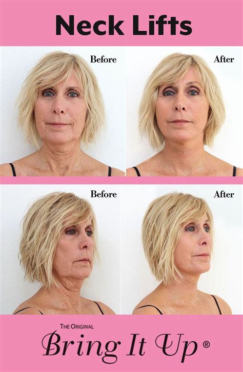 Look At The Incredible Difference Neck Lifts Make Bring It Up Is Here