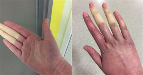Raynauds Disease Causes White Or Blue Fingers Toes In Cold