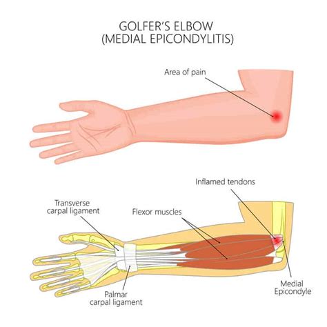 Elbow Conditions Elbow Injuries Form Hand Wrist And Elbow Institute