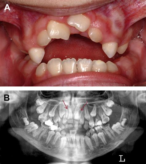 Figure 5 From The Genetic Basis Of Inherited Anomalies Of The Teeth