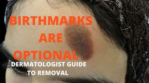 How To Remove Birthmarks Youtube