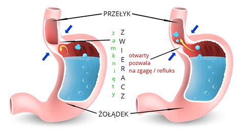 Refluks Zgaga I Nadkwasota Leczenie Profilaktyka Naturalnie