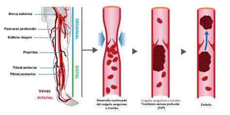 It prevents blood from flowing normally through the circulatory system. Como prevenir la trombosis venosa - El Men