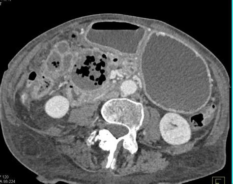 Abscess With Air In The Region Of The Gallbladder Gastrointestinal