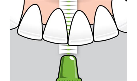 How To Use Interdental Brushes