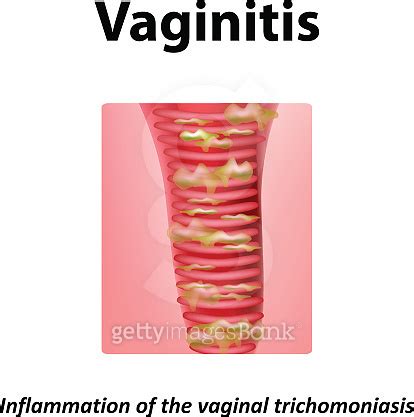 Inflammation Of The Vagina Vaginitis Trichomoniasis Infographics