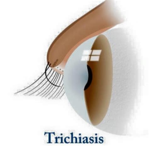 Trichiasis The Ingrowing Eyelashes — Kiddies Eye Care