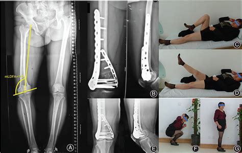 Medial Open‐wedge Osteotomy With Double‐plate Fixation For Varus