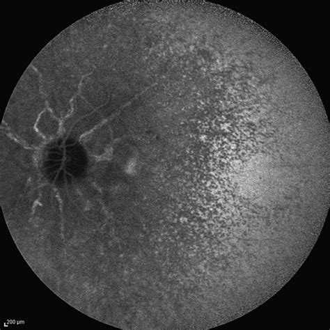 Angioid Streaks And Cnv Fig 4 Retina Image Bank