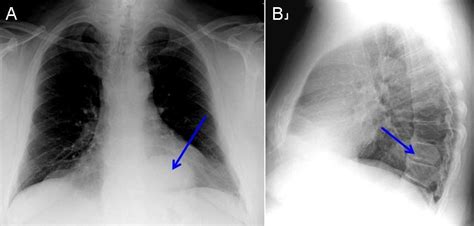 Southwest Journal Of Pulmonary Critical Care And Sleep Imaging