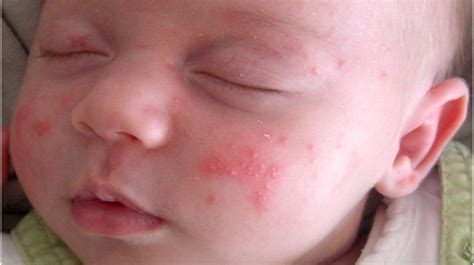 Newborn Rash On Face