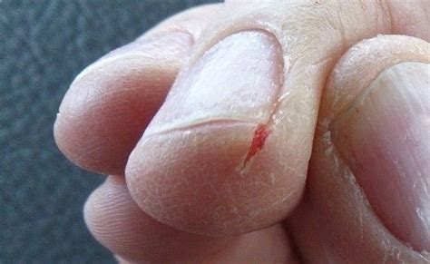 Dry Or Cracked Fingertips Could Be The Sign Of Problems Like Psoriasis