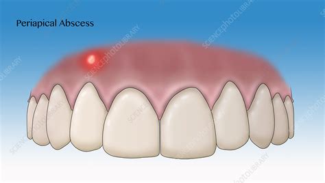 Periapical Abscess Illustration Stock Image C0366288 Science