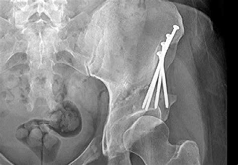 Bilateral Hip Dysplasia When To Preserve And When To Replace